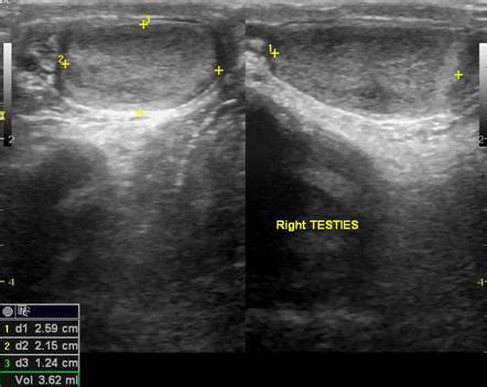 Imaging results do not alter management recommendations per American Urological Association clinical guidelines. ... Testicular atrophy index on ultrasonography Laboratory tests Comments; 0% to 24%: . Testicular atrophy radiology